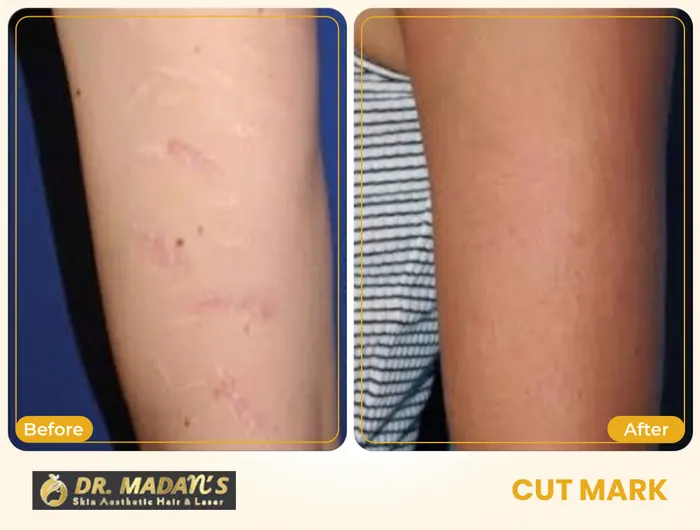 Cut mark before and after result 4 at Dr Madan Aesthetics